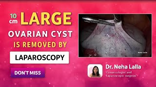 2022 Ovarian Cyst Signs and Symptoms  Scarless Laparoscopic Treatment  Dr Neha Lalla [upl. by Amekahs613]