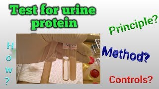 Urine protein test by SSA [upl. by Hessler]