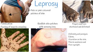 Leprosy signs and symptoms Treatment Hansens Disease [upl. by Easter679]