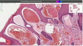 Angiokeratoma  Histopathology [upl. by Iosep402]