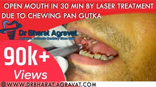 Mouth opening treatment in 30 minutes by laser due to chew paan gutka Ahmedabad India [upl. by Beore110]