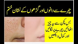 Acne And Pimple Marks Removal Cream  Dano K Nishan Khatam Karne Ki Tips [upl. by Mackintosh]