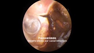 专业可视采耳严重的耳道无菌感染Severe sterile ear canal infection2023092505 [upl. by Avalsorim]