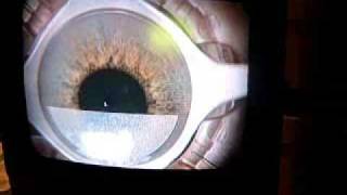 Cataract Surgery 101  Monofocal vs Multifocal IOLs  What is my Plane of Focus [upl. by Adim244]