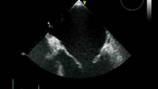 MITRAL CLIP PATIENT SELECTION [upl. by Ornstead516]