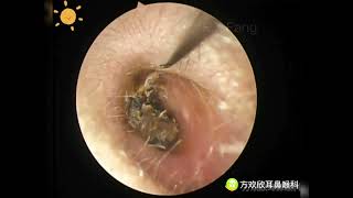 Ear wax removalFungus cleaning Ear canal cleaningEndoscopic Ear Treatment（外耳道清理，真菌感染清理）20230813 [upl. by Enilauqcaj]