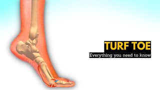 Dont Let Turf Toe Slow You Down How to Heal and Recover Fast [upl. by Leugim487]