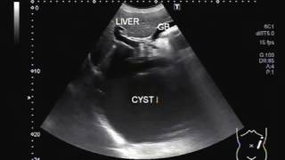 Ultrasound Video showing a large cyst in Liver [upl. by Manson]