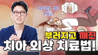 부러지고 깨진 앞니 치아외상 😨 어떻게 깨졌느냐에 따라 치료방법이 달라집니다 야외활동 많아지는 지금 딱 필요한 영상 👍 [upl. by Anire]