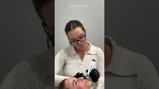 Elucells Skin Needling Treatment A Comprehensive Overview of Its Benefits [upl. by Celisse]