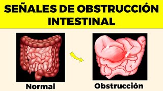 Señales de Alerta de OBSTRUCCIÓN INTESTINAL Que Nunca Debes Ignorar [upl. by Danika501]