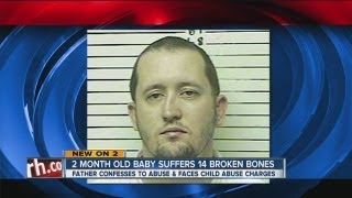 Police Abused baby has 14 broken bones [upl. by Imis]