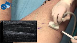 Marking hidden varicose veins for ultrasound guided phlebectomies [upl. by Yahs]