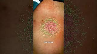 Ringworm 🪱😱 Explained [upl. by Ardnama]