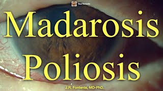 Madarosis y Poliosis [upl. by Mena596]