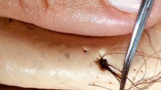 Removal of ingrown hair [upl. by Sadonia569]