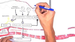 Burns DETAILED Overview  Types Pathophysiology TBSA [upl. by Eidurt]