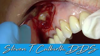 Apicoectomy with Bone Graft and Membrane  with Steven T Cutbirth DDS [upl. by Natsirt]