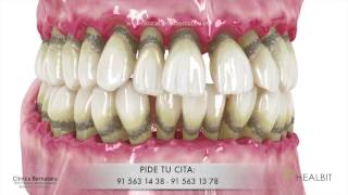 Periodoncia  gingivitis y periodontitis o quotpiorreaquot [upl. by Ammann]