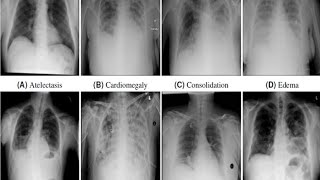 Chest Xray Pathology  Radiology  Education 123radiology 123radiology Radiologando [upl. by Htebesile]