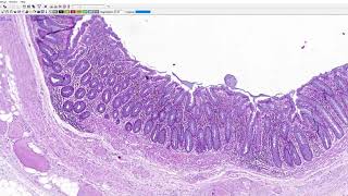 SWU Pathology Talk lab GI pathology Colonic diverticulosis [upl. by Jasmine]