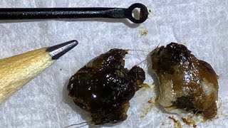 45  Huge Ear Wax Plugs Extracted with Jobson Horne using the WAXscope®️ [upl. by Agamemnon]