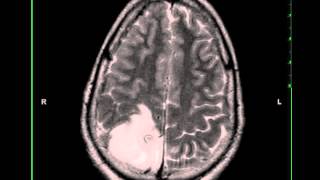 Oligodendroglioma [upl. by Losyram]