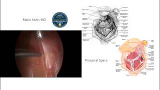 Laparoscopic Presacral Neurectomy [upl. by Natividad]