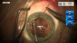 Pupil Cerclage with Multifocal Toric IOL [upl. by Darya]