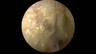 Transorbital approach to middle cranial fossa and cavernous sinus [upl. by Onidranreb379]