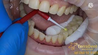 Stomatologie ChisinauBotanicaTerraDentCoroane dentare din Ceramica cu suport ZIRCONIU PE IMPLANT [upl. by Batruk]