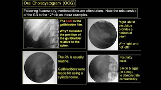 Radiography of the biliary system [upl. by Bibi]