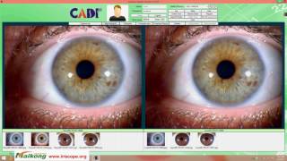 how to use the 2017 maikong version iridology skin hair 3 in 1 PRO software [upl. by Idnir5]