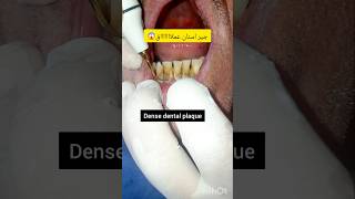 ازالة وتنظيف جير الاسنان ازالة بلاكوالاسنات والقلح dentist stitch اكسبلور stitchlover ترند [upl. by Clementia666]