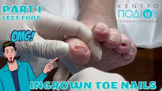 Ingrown ToenailΕίσφρυση όνυχος callus κεντροποδιου footcare podologos podiatrist podiatry [upl. by Reppep333]