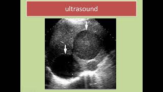 Liver Abscess Symptoms diagnosis and treatment  General Surgery Lecture  Ample Medical Lectures [upl. by Clements]