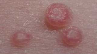 How to treat Molluscum Contagiosum [upl. by Saxena120]