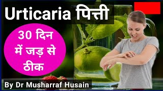 Urticaria Treatment in Hindi  पित्ती उछलने का जड़ से इलाज  Urticaria Ka Permanent ilaj [upl. by Asilegna989]