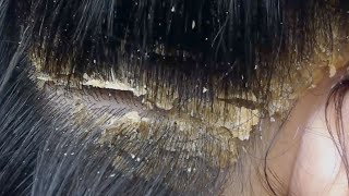 Dandruff scratching removal on head using black combing10 [upl. by Phip925]