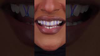 Dental Editing Before After dentalcare dentalhygiene dentalphotography caries dent dental [upl. by Russel689]