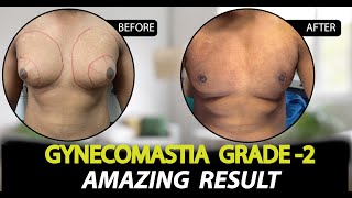 Gynecomastia Surgery in Jaipur  Patient Feedback  Dr Deepesh Goyal  Rejuvena Cosmo Care [upl. by Anisirhc]