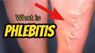 What is Phlebitis [upl. by Neetsirhc]