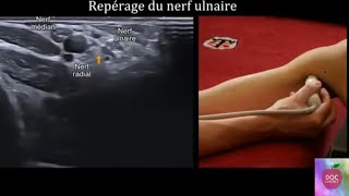 Echographie du nerf ulnaire cubital [upl. by Deth]