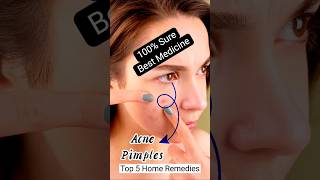 Pimples pigmentation💯 home solution shorts pimplehelphealthpigmentation shortsfeedtrending [upl. by Akcemat]