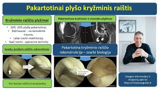 Pakartotinai plyšo kryžminis raištis [upl. by Arahset]