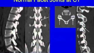 UCSF Radiology What is Scoliosis [upl. by Hoisch992]