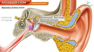 Atticoantral Chronic Suppurative Otitis Media CSOM and Cholesteatoma 🦻💡quot  Animated ENT Lectures [upl. by Irrej]