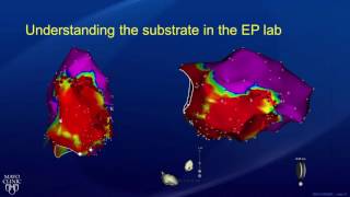 Ablation Treatment for Ventricular Tachycardia  Part 2 [upl. by Noel]