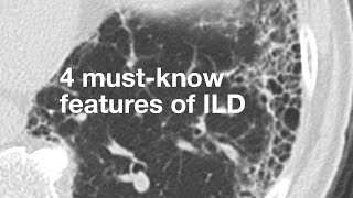 4 MustKnow Features of ILD [upl. by Hau]