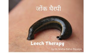 Leech Therapy [upl. by Britt]